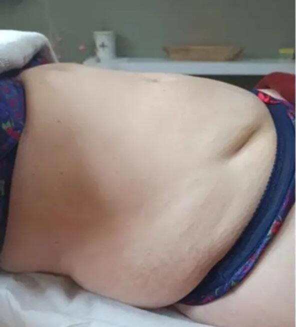 Drainage lymphatique - Avant