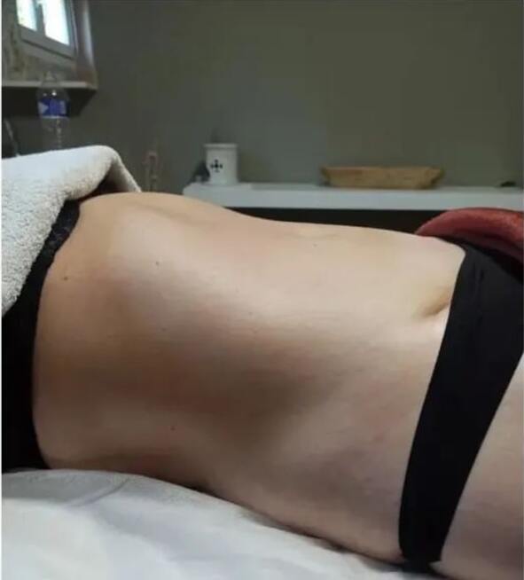 Drainage lymphatique - Après